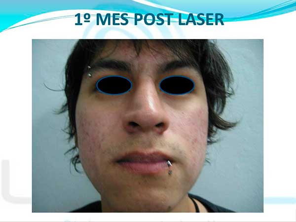 1-mes-post-laser