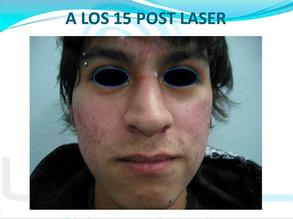 15-post-laser